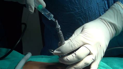 drop the needle test|hanging drop test laparoscopic procedure.